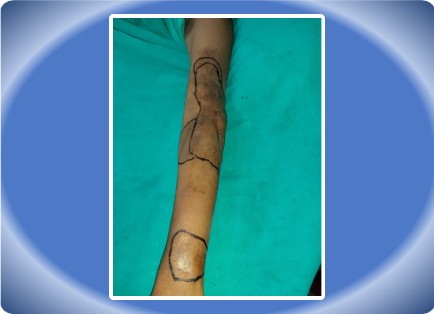POST BURN SCAR